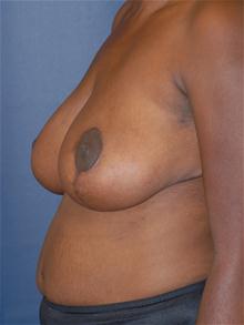 Breast Reduction After Photo by Michael Eisemann, MD; Houston, TX - Case 27446