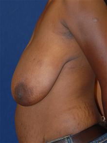 Breast Reduction Before Photo by Michael Eisemann, MD; Houston, TX - Case 27446
