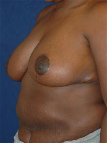 Breast Reduction After Photo by Michael Eisemann, MD; Houston, TX - Case 27447