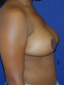 Breast Reduction After Photo by Michael Eisemann, MD; Houston, TX - Case 27449
