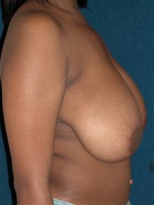 Breast Reduction Before Photo by Michael Eisemann, MD; Houston, TX - Case 27449