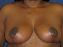 Breast Reduction After Photo by Michael Eisemann, MD; Houston, TX - Case 27451