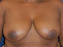 Breast Reduction Before Photo by Michael Eisemann, MD; Houston, TX - Case 27451