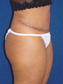 Tummy Tuck After Photo by Michael Eisemann, MD; Houston, TX - Case 27452