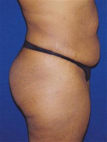 Tummy Tuck Before Photo by Michael Eisemann, MD; Houston, TX - Case 27452