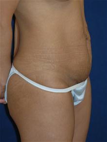 Tummy Tuck Before Photo by Michael Eisemann, MD; Houston, TX - Case 27453
