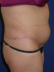 Tummy Tuck After Photo by Michael Eisemann, MD; Houston, TX - Case 27454