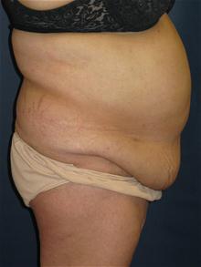 Tummy Tuck Before Photo by Michael Eisemann, MD; Houston, TX - Case 27454