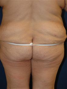 Tummy Tuck Before Photo by Michael Eisemann, MD; Houston, TX - Case 27454