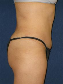 Tummy Tuck After Photo by Michael Eisemann, MD; Houston, TX - Case 27455