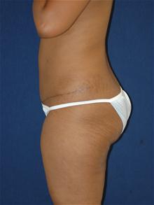 Tummy Tuck After Photo by Michael Eisemann, MD; Houston, TX - Case 27533