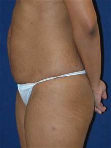 Tummy Tuck Before Photo by Michael Eisemann, MD; Houston, TX - Case 27533