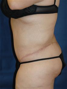 Tummy Tuck After Photo by Michael Eisemann, MD; Houston, TX - Case 27534