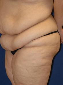 Tummy Tuck Before Photo by Michael Eisemann, MD; Houston, TX - Case 27534