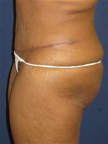 Tummy Tuck After Photo by Michael Eisemann, MD; Houston, TX - Case 27536