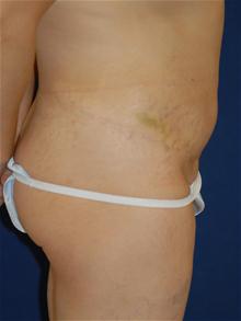 Tummy Tuck After Photo by Michael Eisemann, MD; Houston, TX - Case 27537