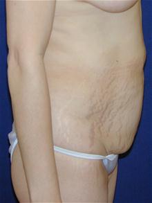 Tummy Tuck Before Photo by Michael Eisemann, MD; Houston, TX - Case 27537
