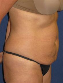 Tummy Tuck Before Photo by Michael Eisemann, MD; Houston, TX - Case 27538
