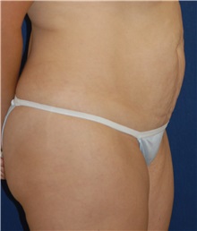 Tummy Tuck Before Photo by Michael Eisemann, MD; Houston, TX - Case 27541