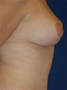 Breast Lift After Photo by Michael Eisemann, MD; Houston, TX - Case 27542