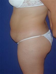 Tummy Tuck Before Photo by Michael Eisemann, MD; Houston, TX - Case 27543