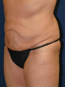 Tummy Tuck Before Photo by Michael Eisemann, MD; Houston, TX - Case 27544
