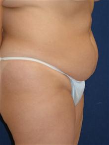 Tummy Tuck Before Photo by Michael Eisemann, MD; Houston, TX - Case 27545