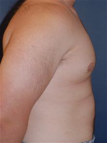 Male Breast Reduction After Photo by Michael Eisemann, MD; Houston, TX - Case 27546