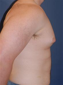 Male Breast Reduction Before Photo by Michael Eisemann, MD; Houston, TX - Case 27546