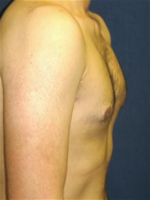 Male Breast Reduction After Photo by Michael Eisemann, MD; Houston, TX - Case 27547