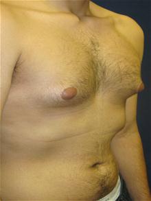 Male Breast Reduction Before Photo by Michael Eisemann, MD; Houston, TX - Case 27547