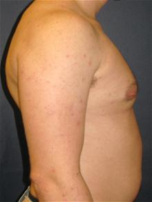 Male Breast Reduction After Photo by Michael Eisemann, MD; Houston, TX - Case 27548