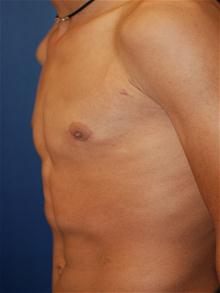 Male Breast Reduction After Photo by Michael Eisemann, MD; Houston, TX - Case 27549