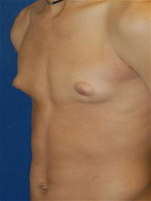Male Breast Reduction Before Photo by Michael Eisemann, MD; Houston, TX - Case 27549