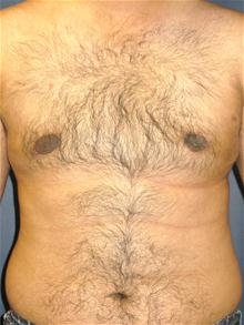 Male Breast Reduction After Photo by Michael Eisemann, MD; Houston, TX - Case 27565