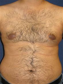 Male Breast Reduction Before Photo by Michael Eisemann, MD; Houston, TX - Case 27565