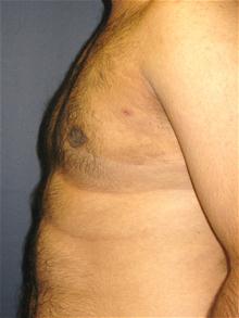 Male Breast Reduction After Photo by Michael Eisemann, MD; Houston, TX - Case 27565