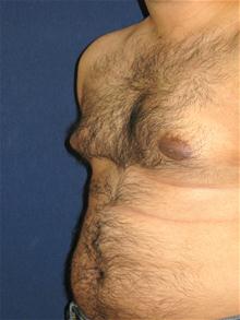 Male Breast Reduction Before Photo by Michael Eisemann, MD; Houston, TX - Case 27565