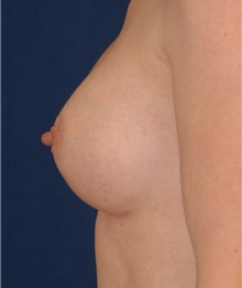 Breast Augmentation After Photo by Michael Eisemann, MD; Houston, TX - Case 27596