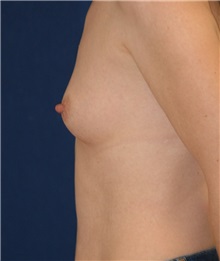 Breast Augmentation Before Photo by Michael Eisemann, MD; Houston, TX - Case 27596