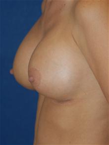 Breast Augmentation After Photo by Michael Eisemann, MD; Houston, TX - Case 27598