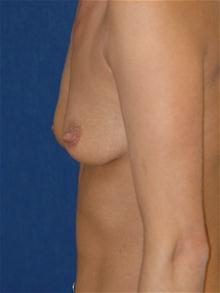 Breast Augmentation Before Photo by Michael Eisemann, MD; Houston, TX - Case 27598