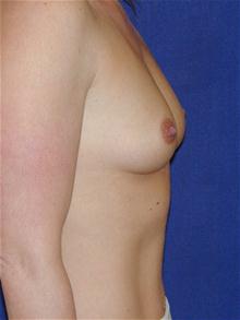 Breast Augmentation Before Photo by Michael Eisemann, MD; Houston, TX - Case 27600