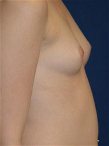 Breast Augmentation Before Photo by Michael Eisemann, MD; Houston, TX - Case 27601