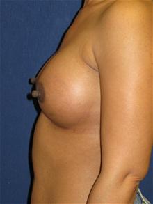 Breast Augmentation After Photo by Michael Eisemann, MD; Houston, TX - Case 27602