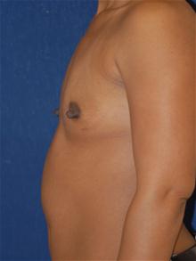 Breast Augmentation Before Photo by Michael Eisemann, MD; Houston, TX - Case 27602
