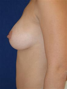 Breast Augmentation After Photo by Michael Eisemann, MD; Houston, TX - Case 27603