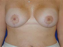 Breast Lift After Photo by Michael Eisemann, MD; Houston, TX - Case 27605