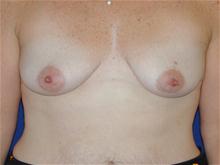 Breast Lift Before Photo by Michael Eisemann, MD; Houston, TX - Case 27605