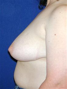 Breast Lift Before Photo by Michael Eisemann, MD; Houston, TX - Case 27608